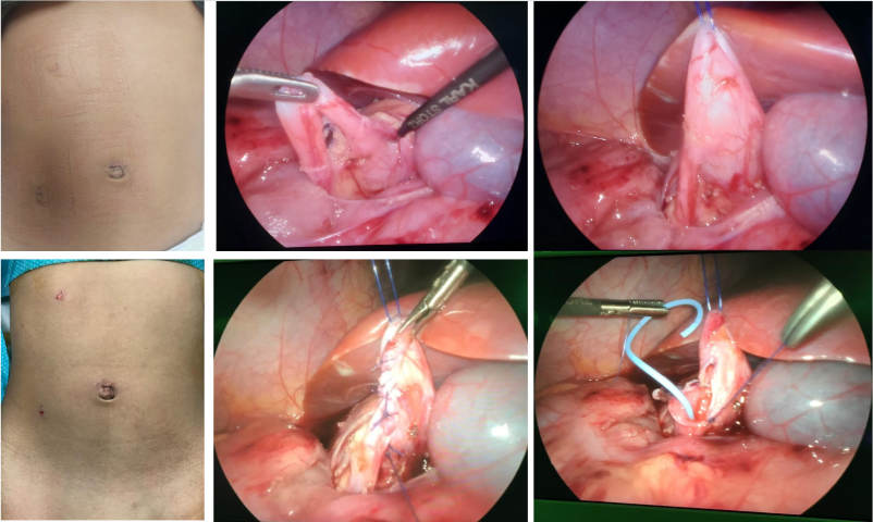 Mini-Laparoscopic Right Pyeloplasty in 3yr Old