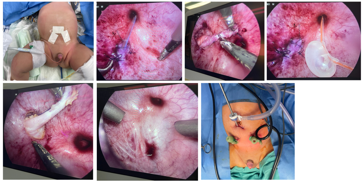 Pneumovesicoscopic Repair for Obstructive Megaureter in 6 Months Old