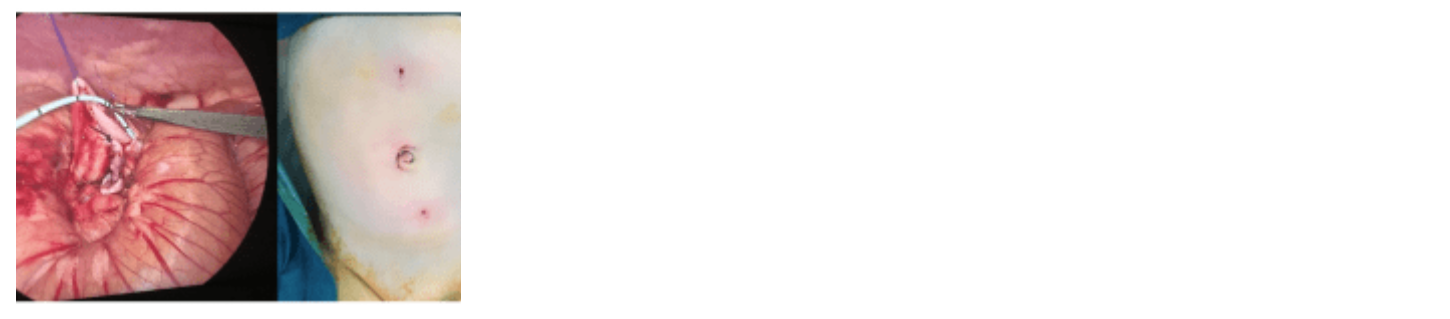 Mini-Laparoscopic Pyeloplasty