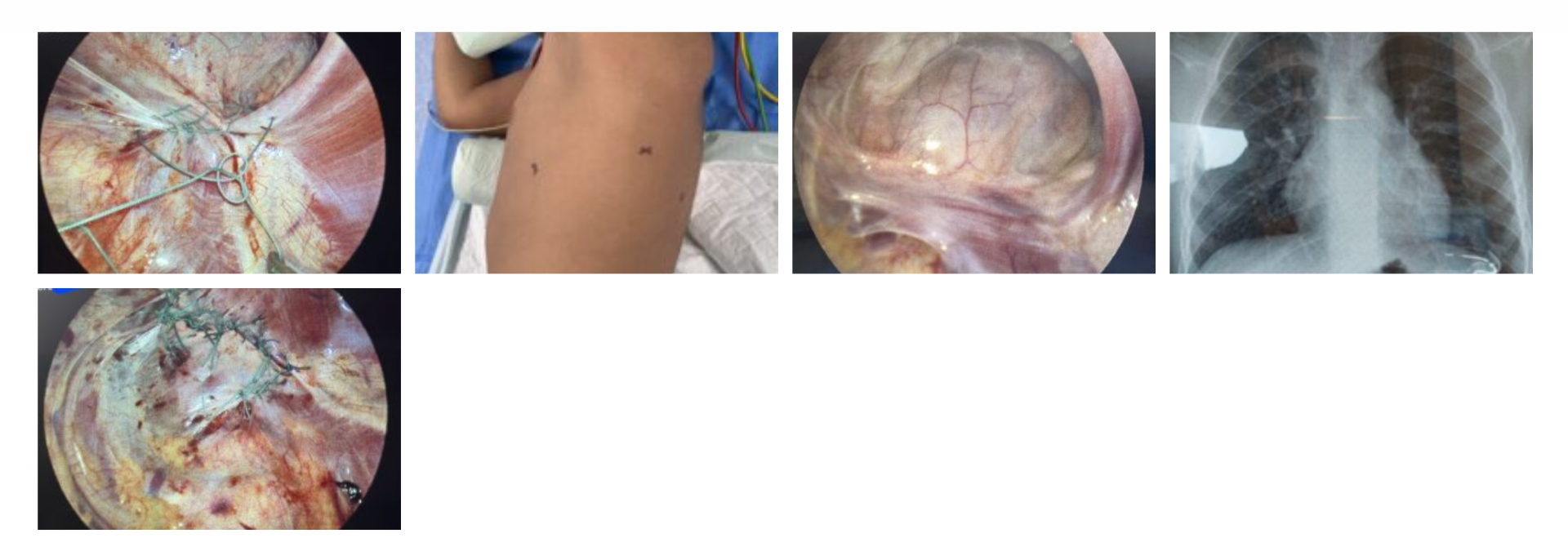 Rare Bilateral Diaphragmatic Hernia Operated Successfully