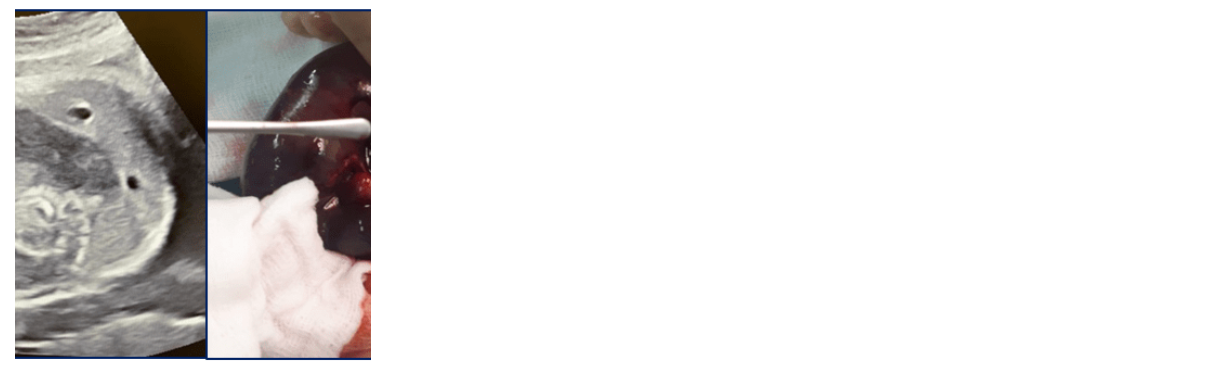 1.3KG Preterm with Rare Type 3 Jejunal Atresia and Meconium Ileus