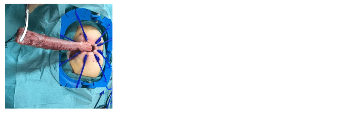 Hybridisation Surgery for Long Segment Hirschsprung's Disease in 10 Months Old Girl