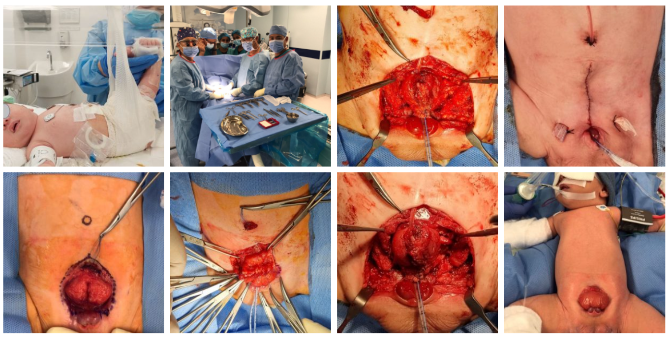 Complete Primary Repair of Exstrophy-Epispadias Complex in a Neonate