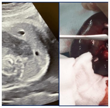 Fetal Volvulus and Gangrene of Intestine Managed Successfully