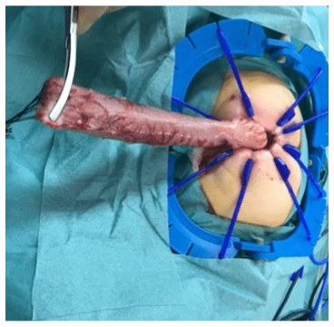 One Stage Trans-anal Swenson's Pullthrough for Hirschsprung Disease in 3 Months Old Girl