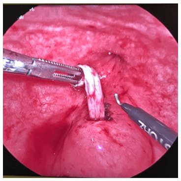 Pneumovesicoscopic Bilateral Ureteric Reimplantation in 4yr Old Child