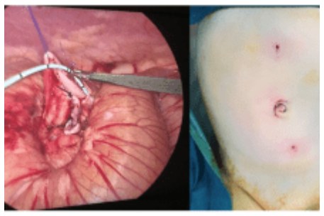 Mini-Laparoscopic Pyeloplasty